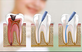 Endodoncia
